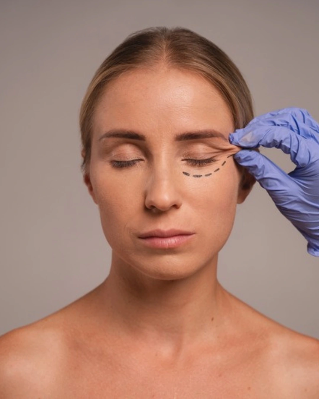 Mirada femenina descansada y natural — blefaroplastia (cirugía de párpados superiores) en Tijuana con el Dr. Alfredo Chama