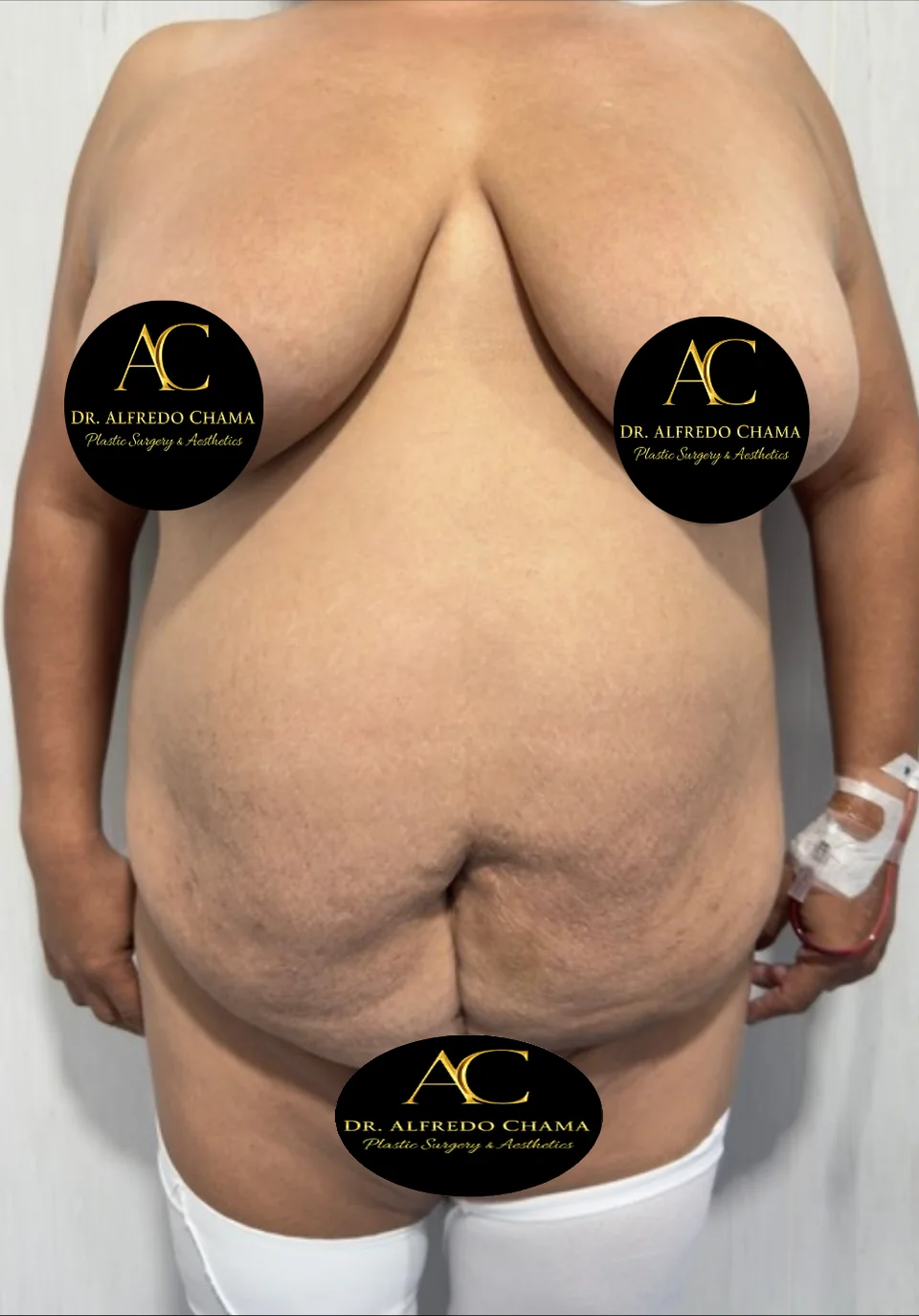 Antes: Abdominoplastia, caso 01.