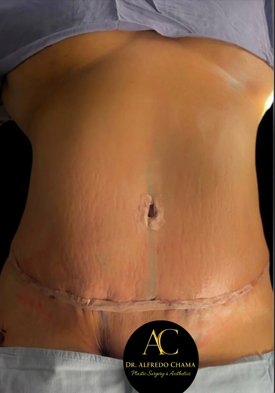Después: Abdominoplastia, caso 01. El después es de su recuperación.