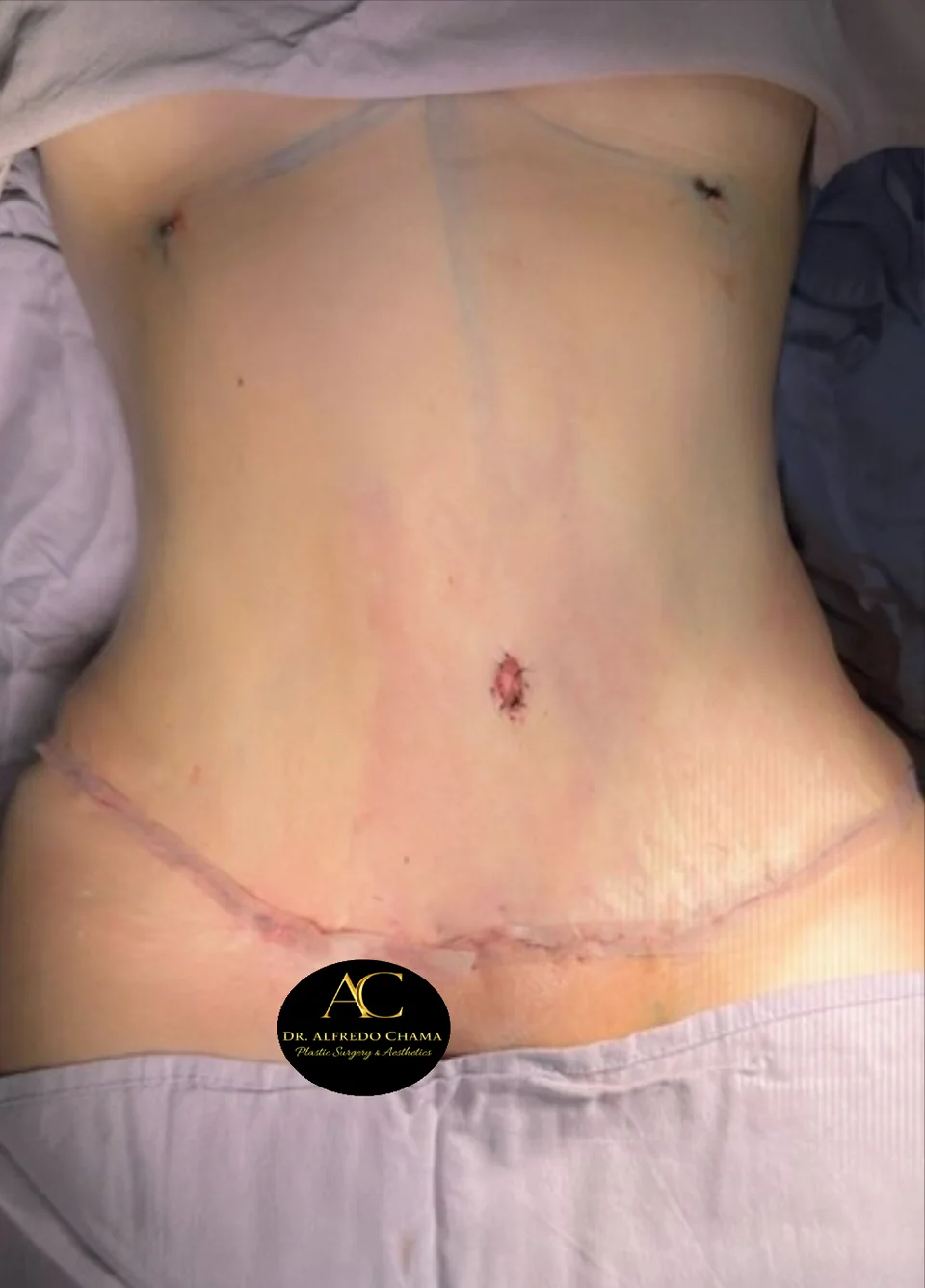 Después: Abdominoplastia, caso 02. El después es al terminar la cirugía.