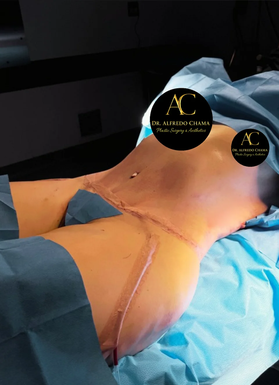 Después: Abdominoplastia, caso 03. El después es al terminar la cirugía.