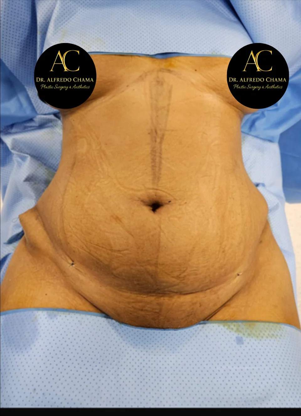 Antes: Abdominoplastia, caso 04.