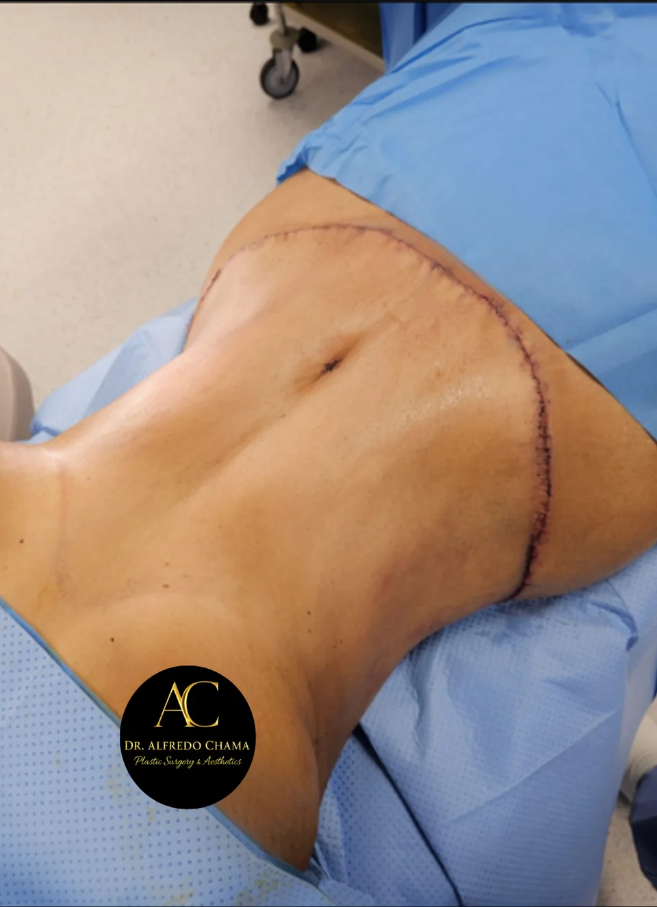 Después: Abdominoplastia, caso 04. El después es al terminar la cirugía.