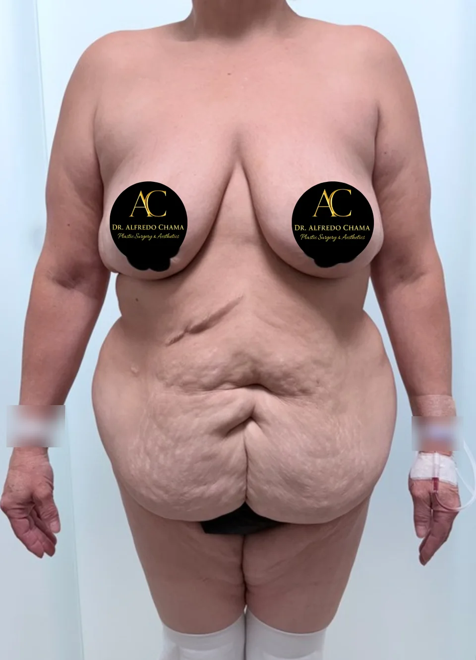 Antes: Abdominoplastia en flor de lis, caso 05.