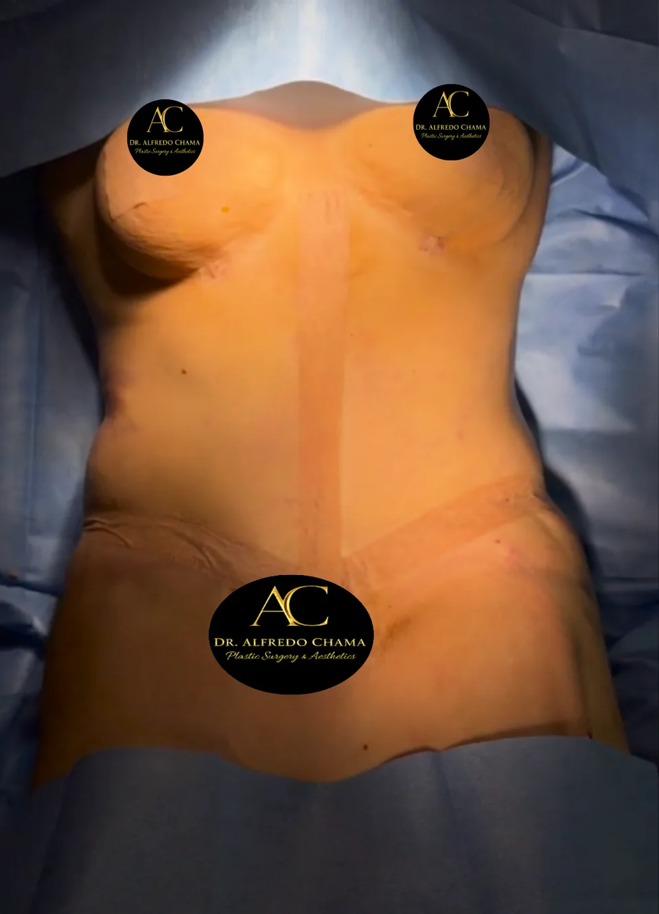 Después: Abdominoplastia en flor de lis, caso 05. El después es al terminar la cirugía.