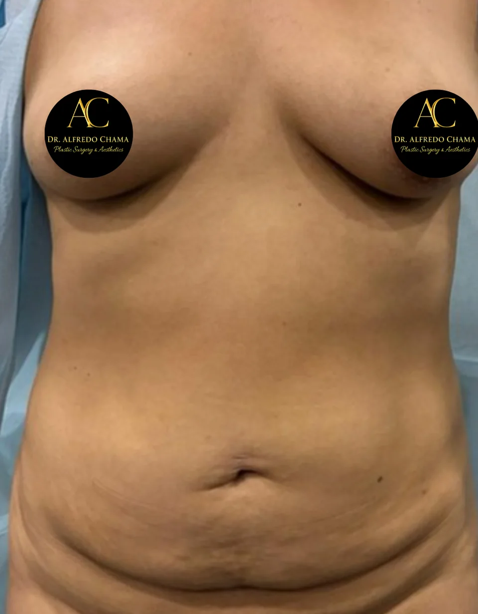 Antes: Aumento de busto + abdominoplastia, caso 01.