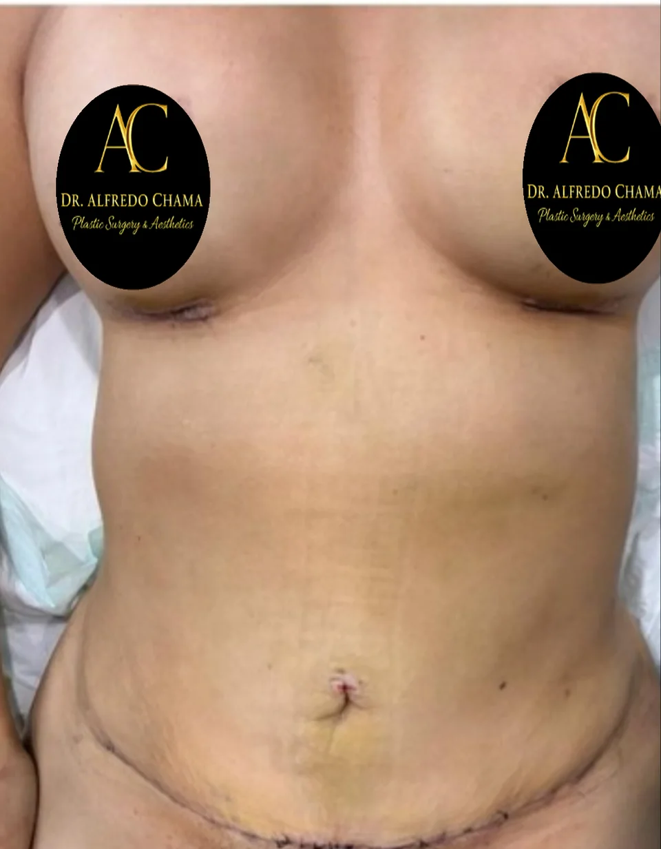 Después: Aumento de busto + abdominoplastia, caso 01. El después es de su recuperación.