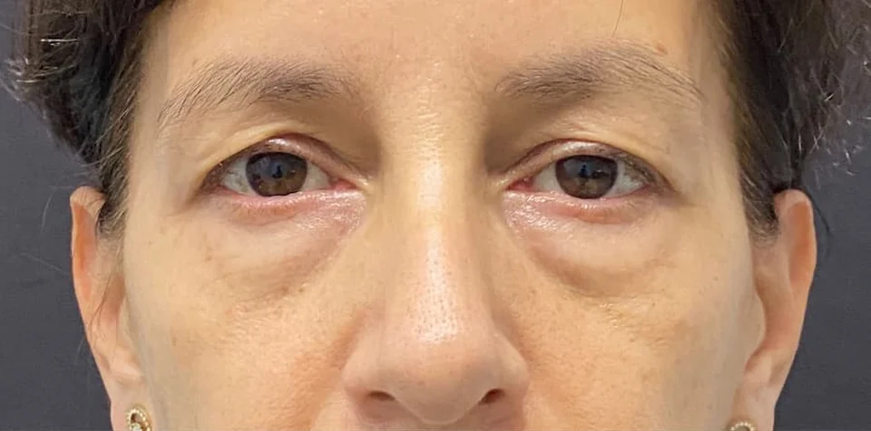 Antes: Blefaroplastia, caso 01.