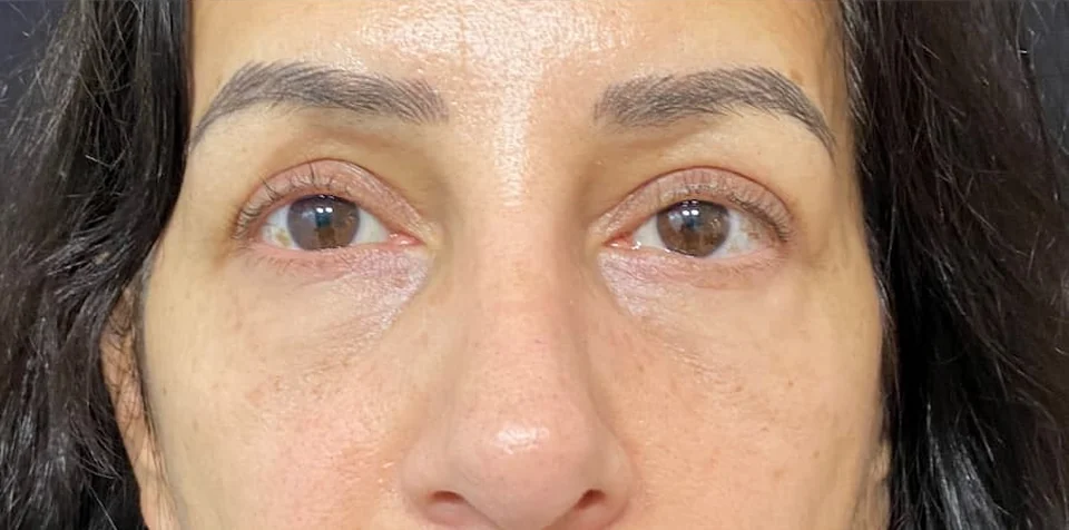 Después: Blefaroplastia, caso 01. El después es de su recuperación.