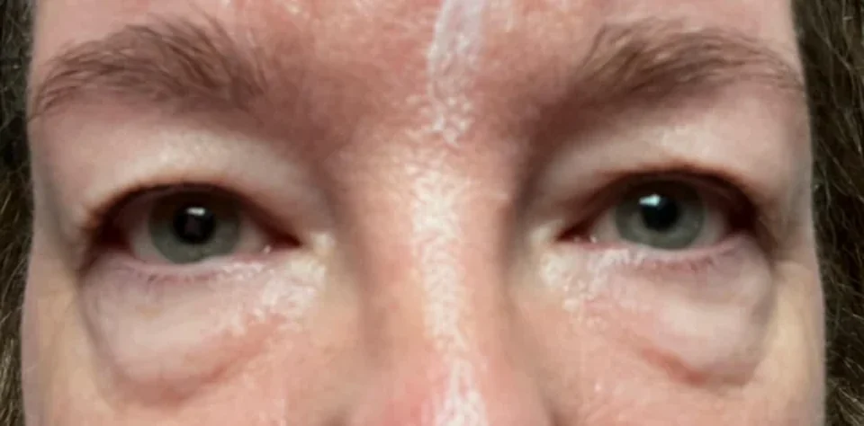 Antes: Blefaroplastia, caso 02.