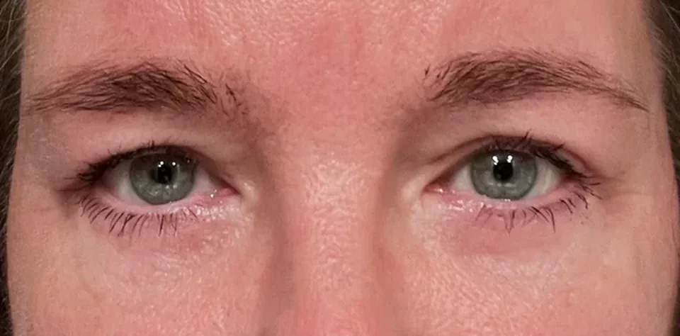 Después: Blefaroplastia, caso 02. El después es de su recuperación.