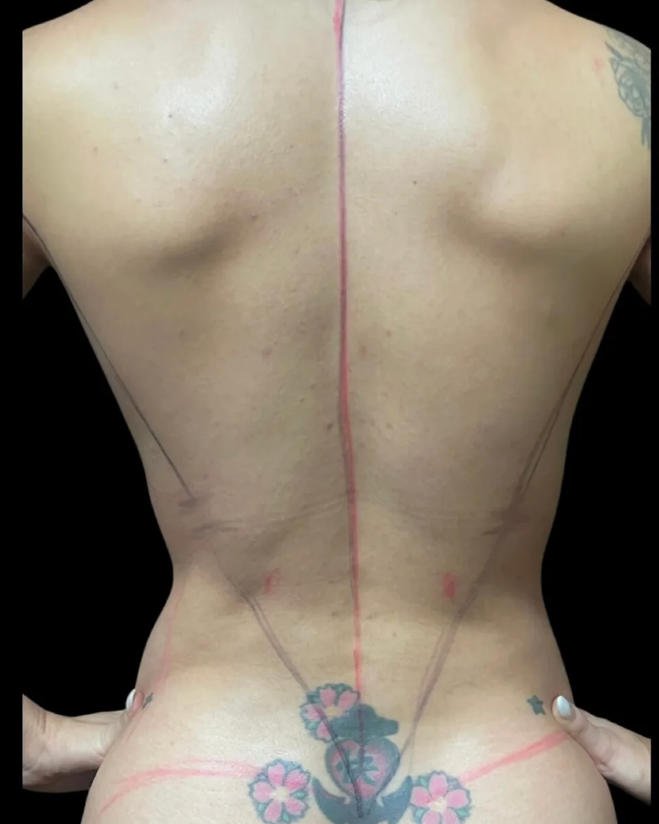 Antes: espalda y cintura, vista posterior, con marcaje preoperatorio