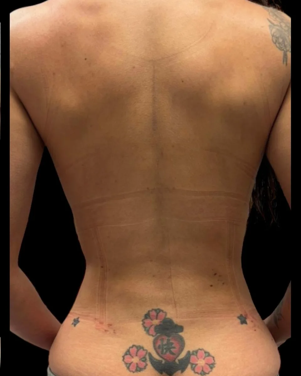 Después: espalda y cintura, vista posterior, postoperatorio