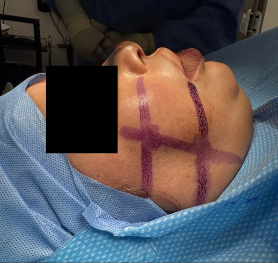 Antes: Lifting facial, caso 05.