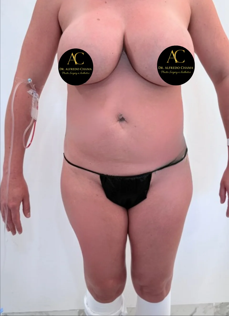 Antes: Liposucción 360, caso 04.