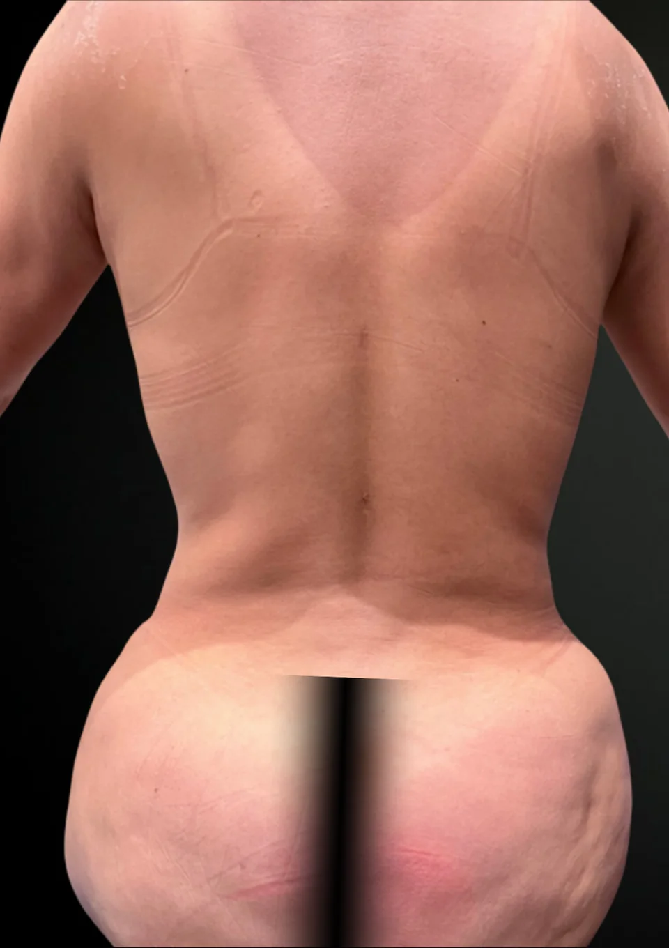 Antes: Liposucción 360 + RibXcare, caso 02.