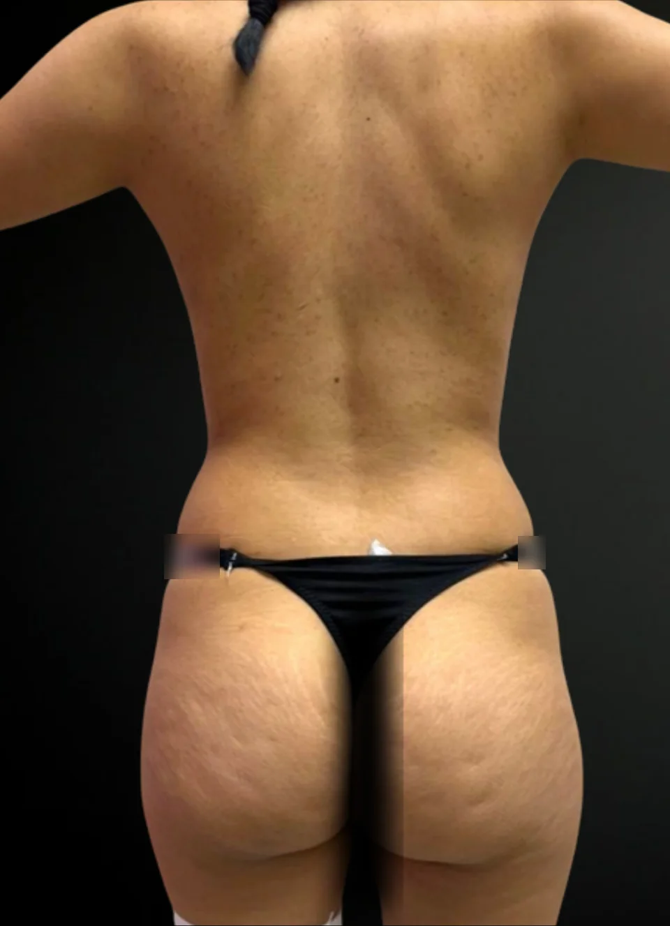 Antes: Liposucción 360 + RibXcare, caso 05.
