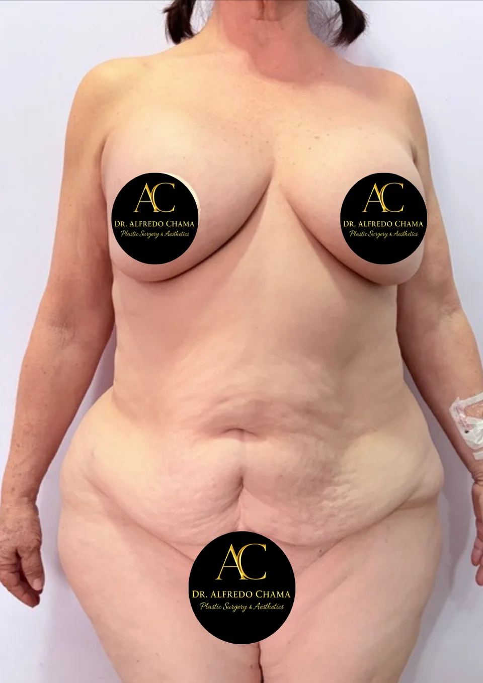 Antes: Mommy makeover, caso 01.