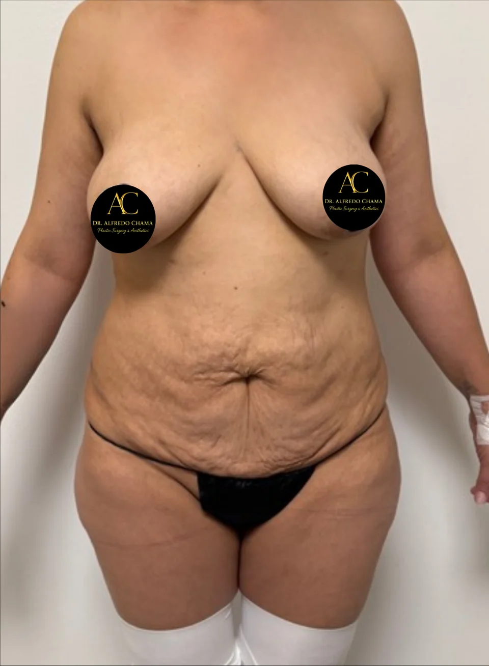 Antes: Mommy makeover, caso 02.