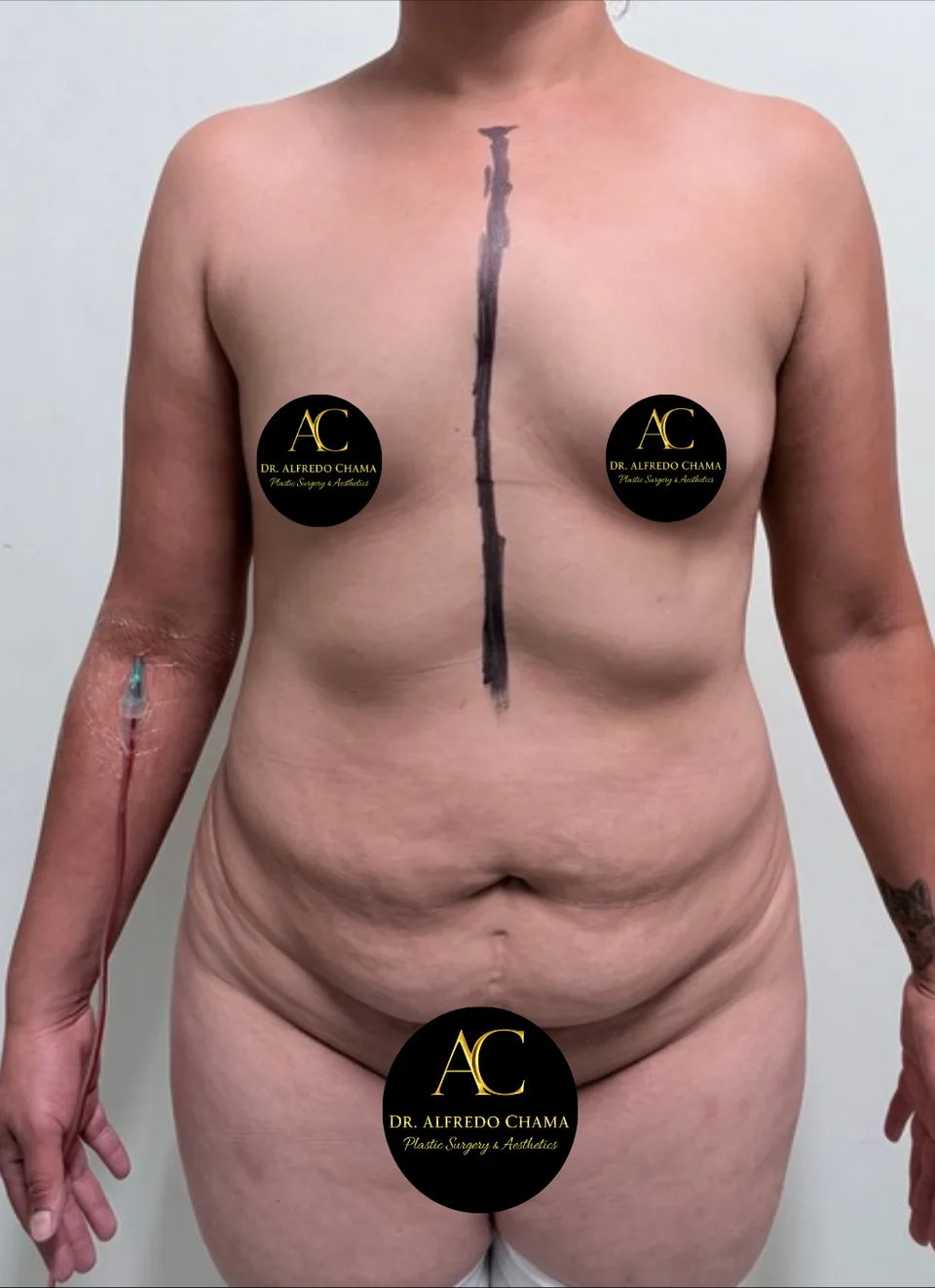 Antes: Mommy makeover, caso 03.