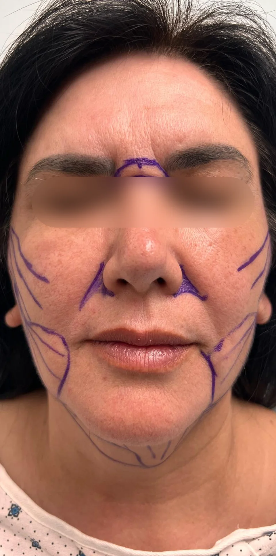 Antes: Rejuvenecimiento facial, caso 02.