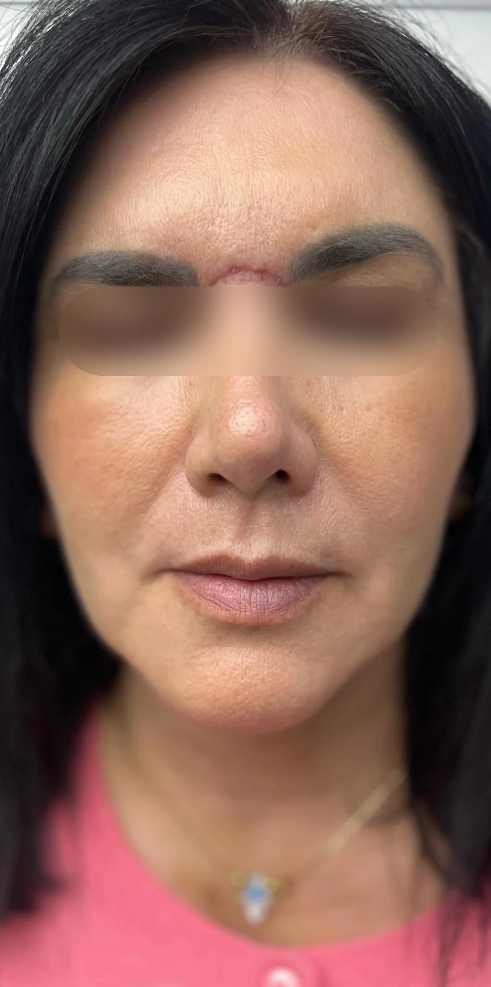 Después: Rejuvenecimiento facial, caso 02. El después es de su recuperación.