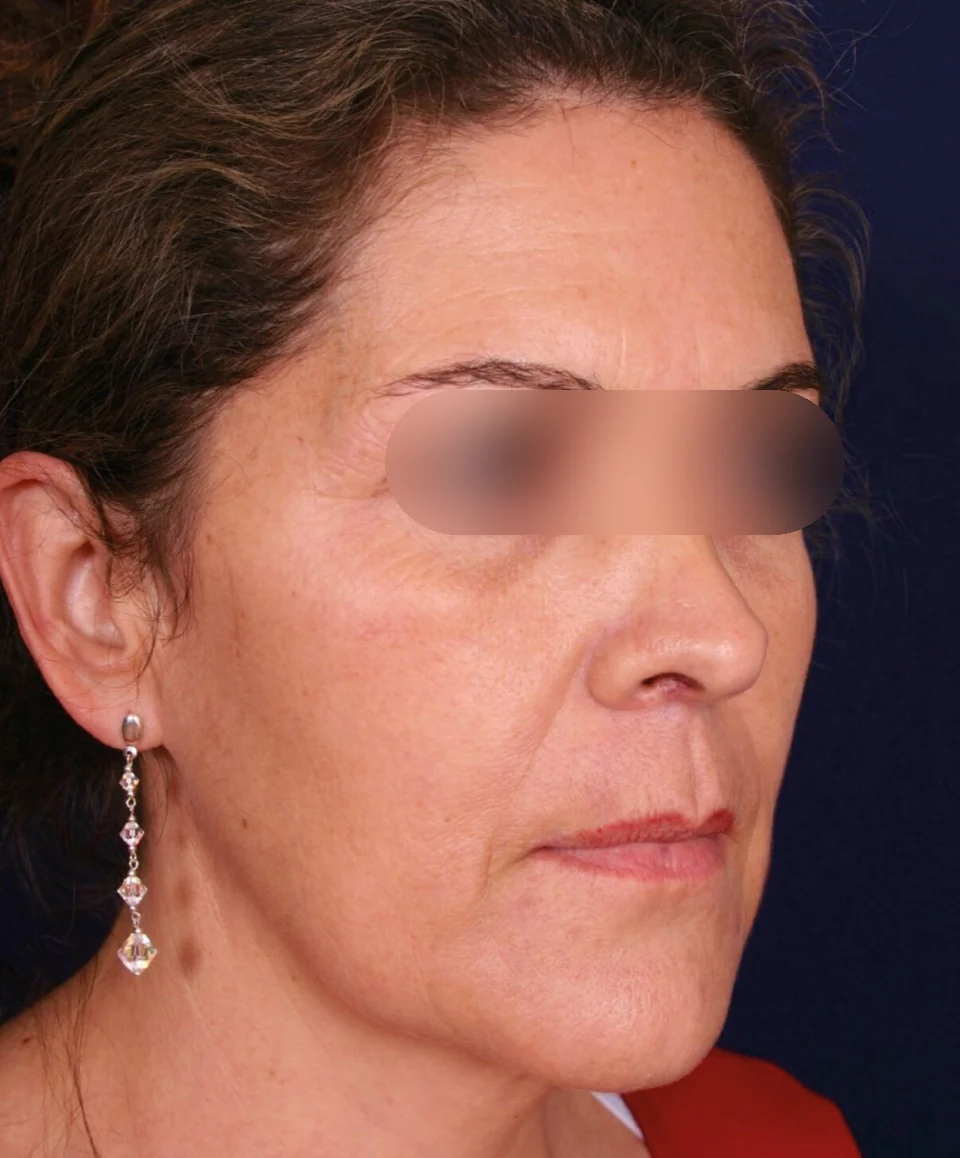 Antes: Rejuvenecimiento facial, caso 03.