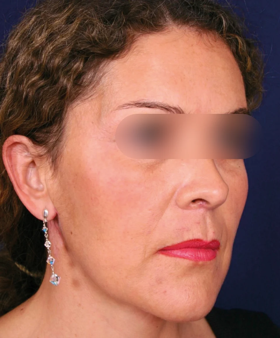 Después: Rejuvenecimiento facial, caso 03. El después es de su recuperación.
