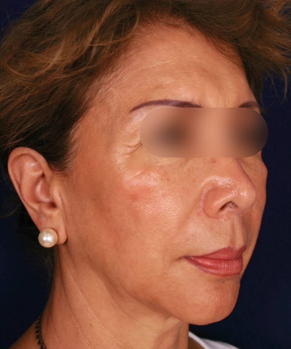 Antes: Rejuvenecimiento facial, caso 04.