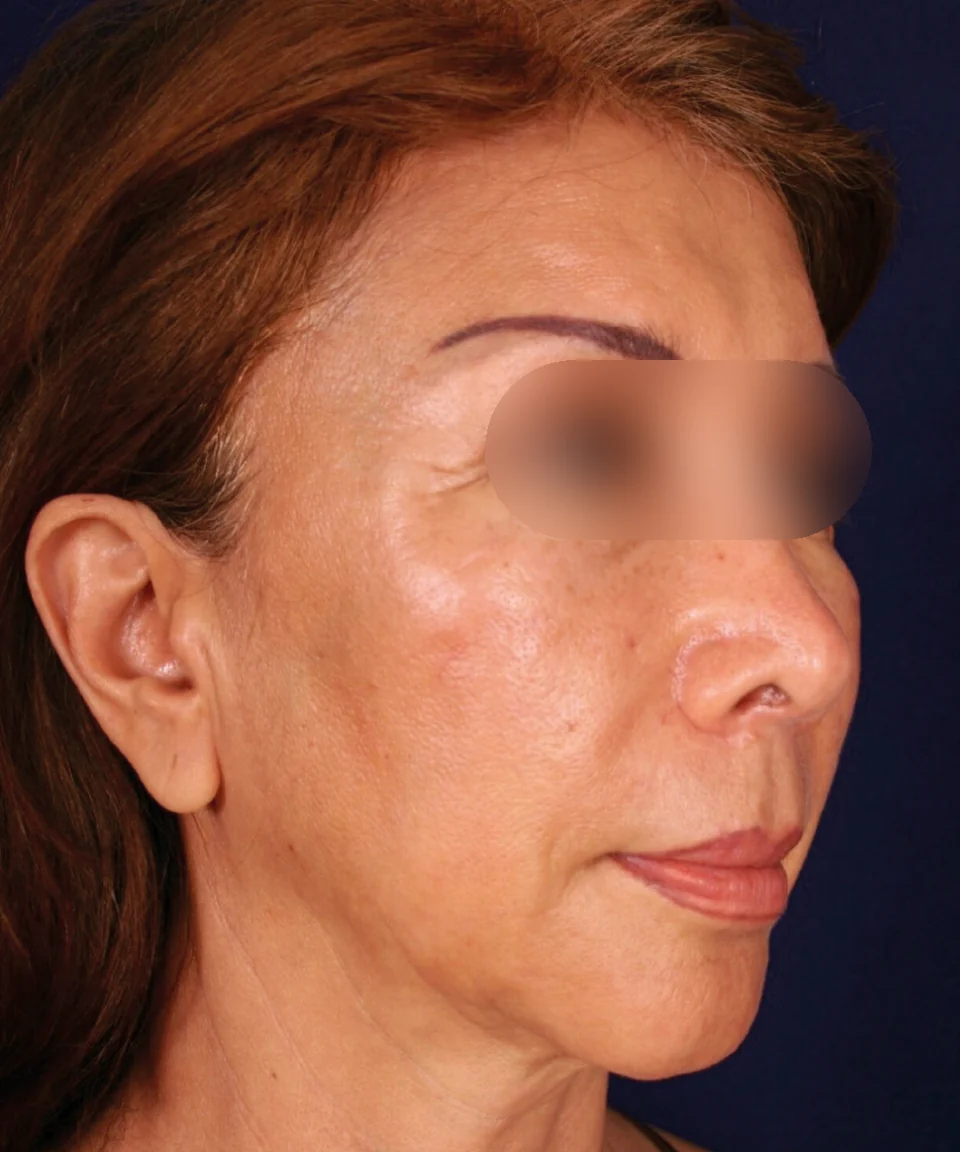 Después: Rejuvenecimiento facial, caso 04. El después es de su recuperación.