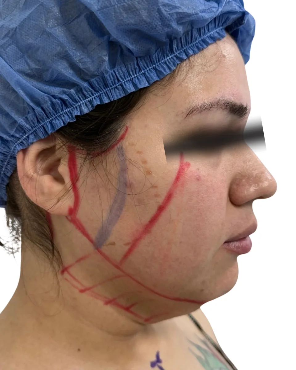 Antes: rostro y cuello, perfil derecho, con marcaje preoperatorio