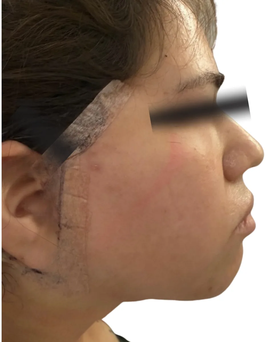 Después: rostro y cuello, perfil derecho, postoperatorio temprano con apósitos